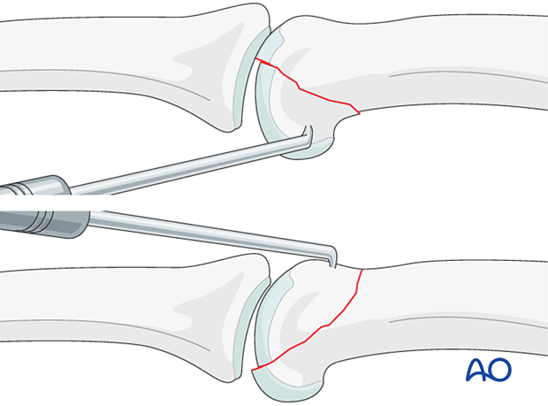 Reduction using a dental pick of fracture-dislocations of the proximal phalanx proximal interphalangeal joint – hand.