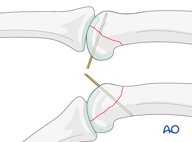 Preliminary K-wire fixation of fracture-dislocations of the proximal phalanx proximal interphalangeal joint – hand.