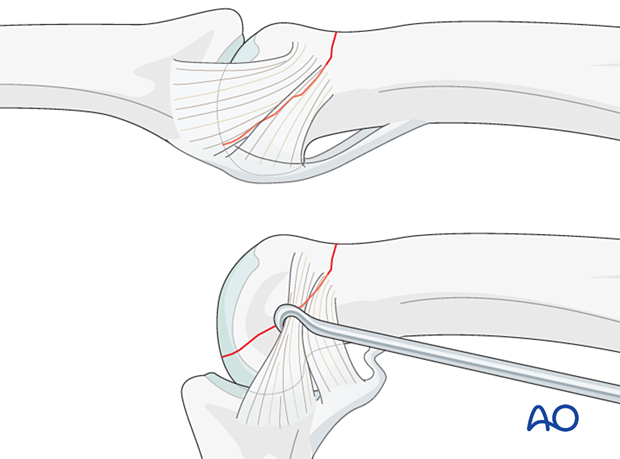 Retraction of the collateral ligament with a hook - dorsal unicondylar fracture-dislocation of the proximal phalanx proximal interphalangeal joint – hand.