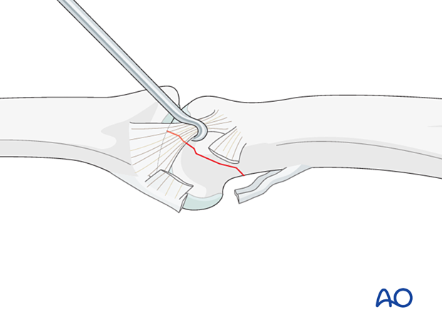 Retraction of the collateral ligament with a hook – palmar unicondylar fracture-dislocation of the proximal phalanx proximal interphalangeal joint – hand.