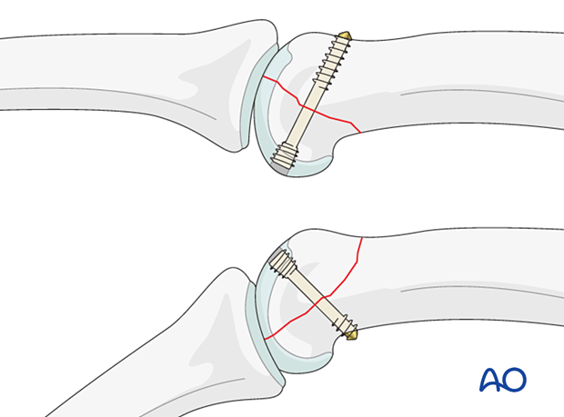 Fixation with a headless compression screw of a volar and a dorsal coronal fragment of a unicondylar fracture dislocation of proximal phalanx joint – hand.