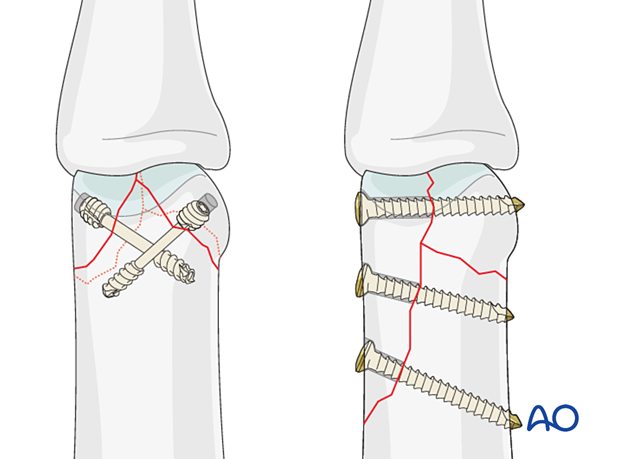 AP view of headless screw fixation of the small fragments of a distal articular complete fracture, and lateral view of cortical lag-screw fixation of the large fragments of a distal articular complete fracture – proximal phalanx – hand.