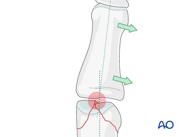 Unicondylar depression may lead to angulation of the finger in articular phalangeal fractures – hand.