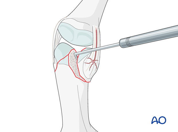 Fracture visualization with a dental pick of a distal articular complete fracture of the proximal phalanx – hand.