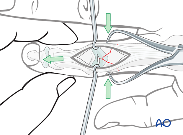 Indirect reduction of the small fragments of a distal articular complete fracture of the proximal phalanx interphalangeal joint – lag-screw fixation – hand.