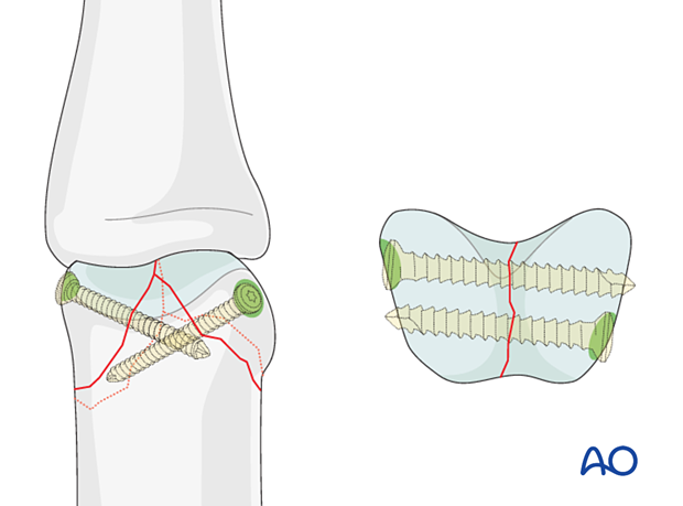 AP and coronal view of cortical screw positioning in small fragments of a distal articular complete fracture of the proximal phalanx interphalangeal joint – lag-screw fixation – hand.