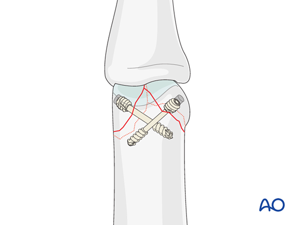 AP view of the fixation with headless screw of the small fragments of a distal articular complete fracture of the proximal phalanx interphalangeal joint – lag-screw fixation – hand.