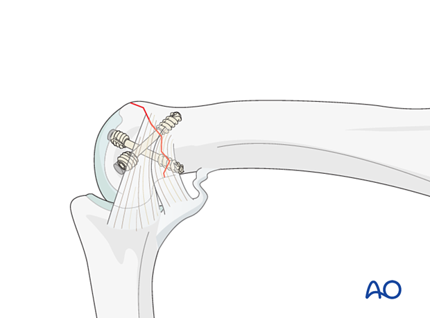 Lateral view of the headless screw fixation in relation to the ligaments – distal articular complete fracture of the proximal phalanx interphalangeal joint – lag-screw fixation – hand.