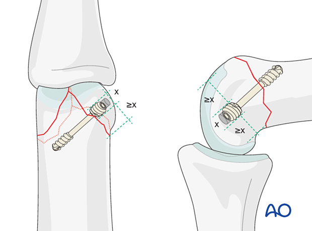 Maximal screw head diameter is one-third of the diameter in a small fragment of a distal articular complete fractures of the proximal phalanx – hand