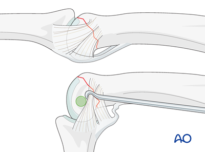 Lag-screw fixation for Complete articular fracture of the distal end ...