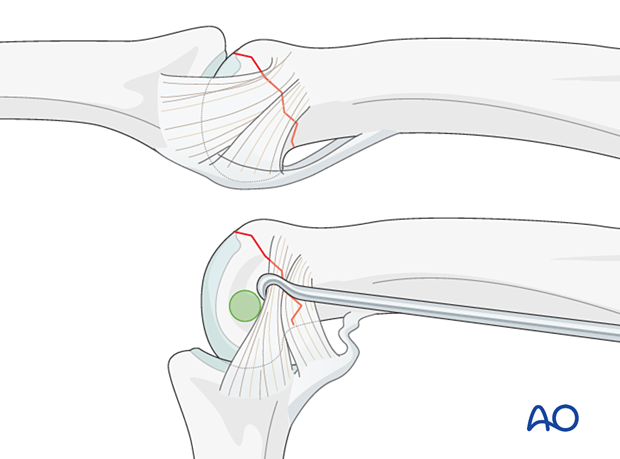 Retraction of the collateral ligament of the proximal interphalangeal joint to access the drill site.  