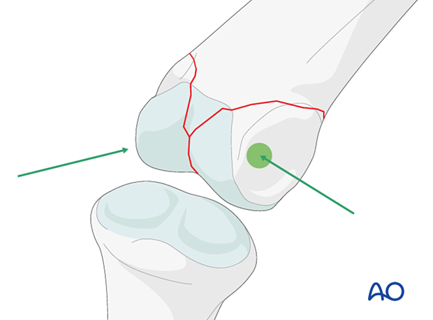 Suitable positions for screw placement – a distal articular complete fracture of the proximal phalanx – hand.