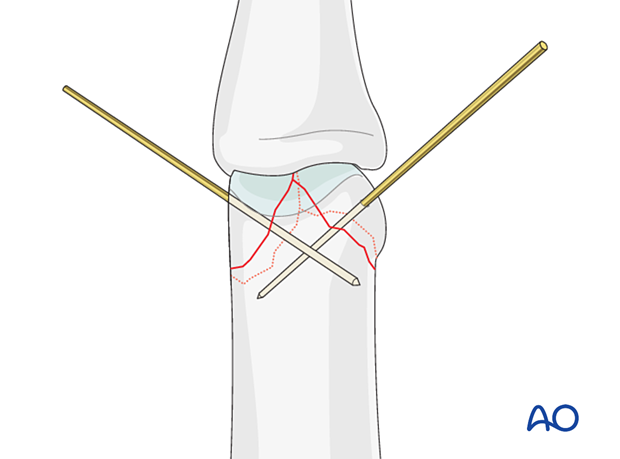 Guide wires insertion – distal articular complete fracture of the proximal phalanx – hand.