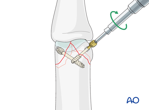 Insertion of the second headless screw– distal articular complete fracture with small fragments of the proximal phalanx – hand.