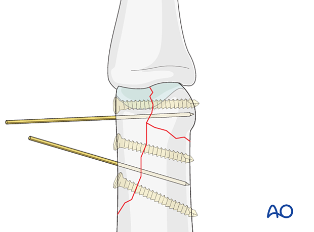 Preliminary fixation with two guide wires prior to lag-screw fixation of a distal articular complete fracture with large fragments – proximal phalanx – hand.