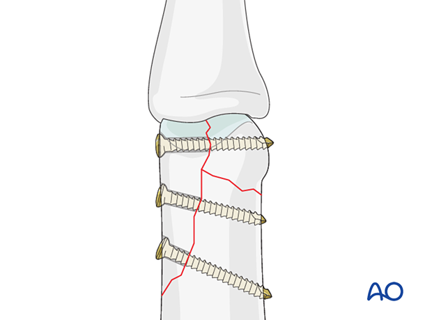 Fixation with three cortical lag screws of distal articular complete fracture with large fragments – proximal phalanx – hand.