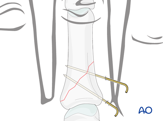 Fixation with two to three K-wires in proximal long oblique or spiral phalangeal hand fractures