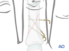 K-wire fixation of an oblique fracture of the proximal phalangeal shaft