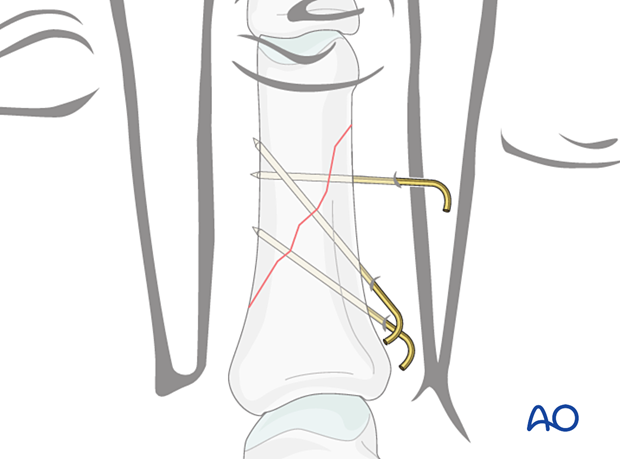 Fixation with two to three K-wires in diaphyseal long oblique or spiral phalangeal hand fractures