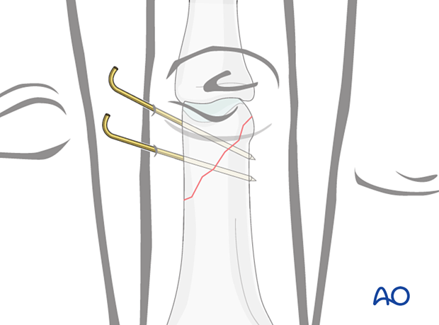 Fixation with two to three K-wires in distal long oblique or spiral phalangeal hand fractures