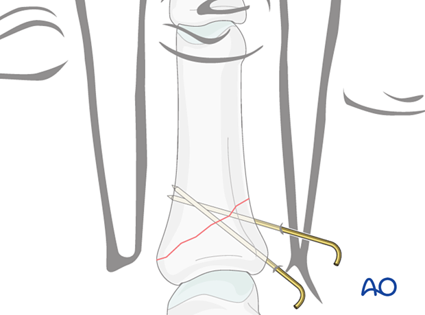 Fixation with two K-wires in short oblique proximal oblique phalangeal hand fractures