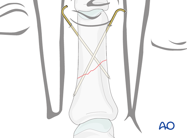 Fixation with two K-wires in short oblique diaphyseal oblique phalangeal hand fractures