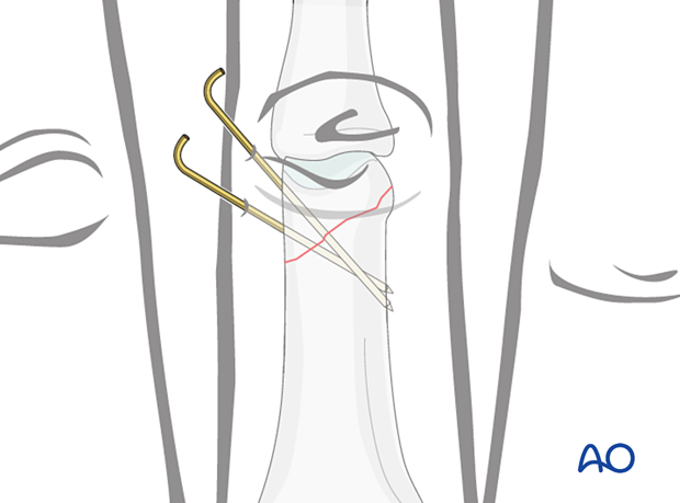 Fixation with two K-wires in short oblique distal oblique phalangeal hand fractures