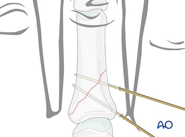 Fixation with two K-wires in short oblique proximal oblique phalangeal hand fractures