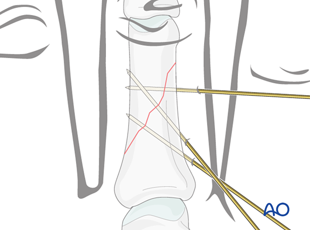 Fixation with two K-wires in short oblique diaphyseal oblique phalangeal hand fractures