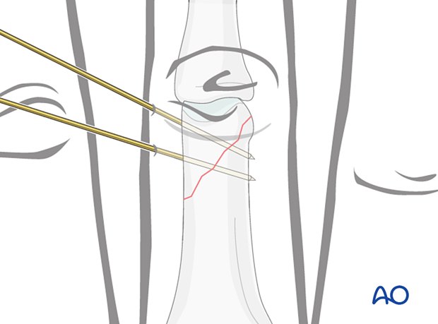 Fixation with two K-wires in short oblique distal oblique phalangeal hand fractures