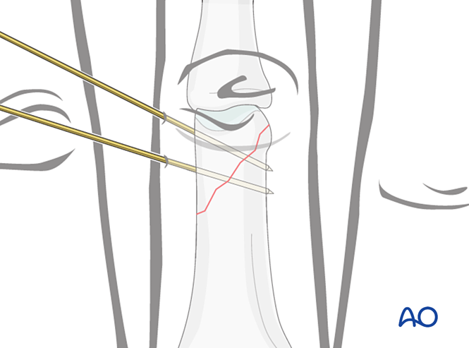 K-wire fixation for Oblique extraarticular fracture of the distal end ...