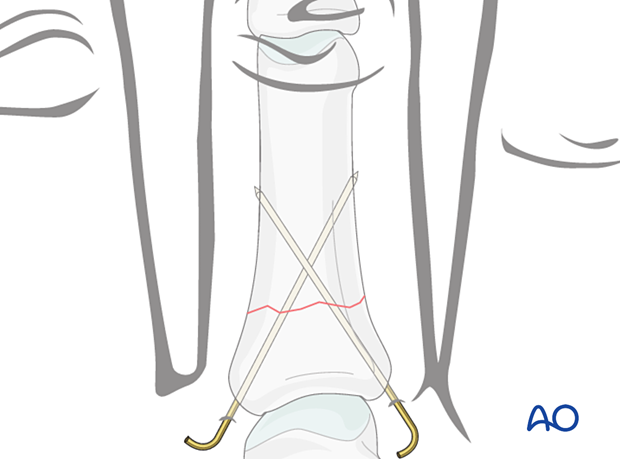 K-wire fixation of a proximal extraarticular transverse fracture of the proximal phalanx – hand.