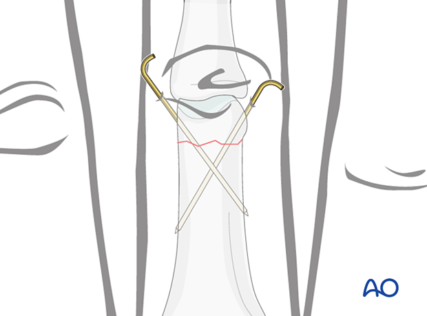 K-wire fixation of a distal extraarticular transverse fracture of the proximal phalanx – hand.