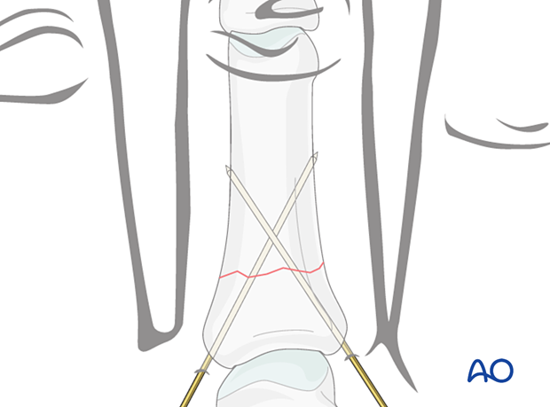 K-wire fixation of a proximal extraarticular transverse fracture of the proximal phalanx – hand.