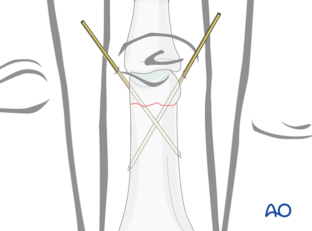 K-wire fixation of a distal extraarticular transverse fracture of the proximal phalanx – hand.