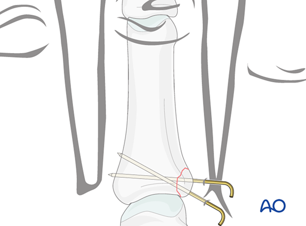 K-wire fixation of a proximal articular avulsion fracture of the proximal phalanx – hand.