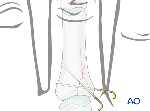 K-wire fixation of a proximal partial articular fracture of the proximal phalanx – hand.