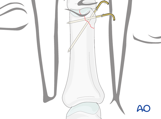 K-wire fixation of a proximal articular avulsion fracture of the distal phalanx – hand