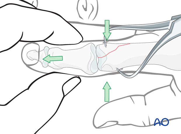 Indirect reduction of a proximal articular avulsion fracture of the distal phalanx – hand.