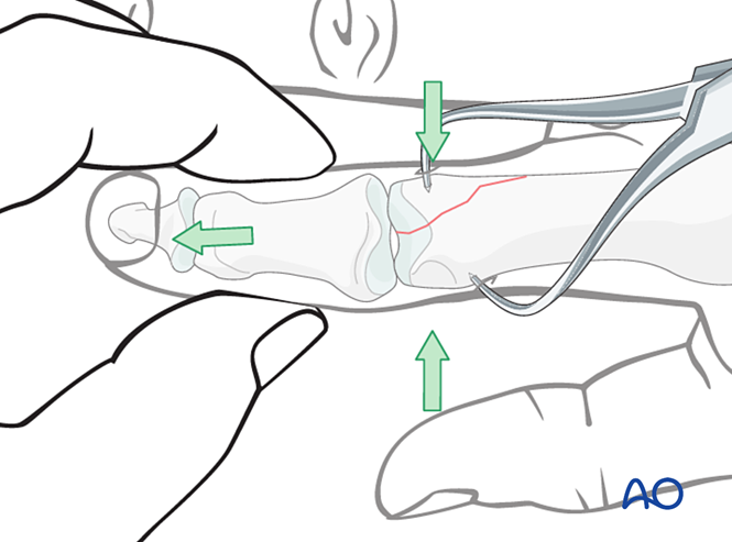 K Wire Fixation For Dislocation And Fracture Dislocation Of The K Wire Fixation For Dislocation And Fracture Dislocation Of The