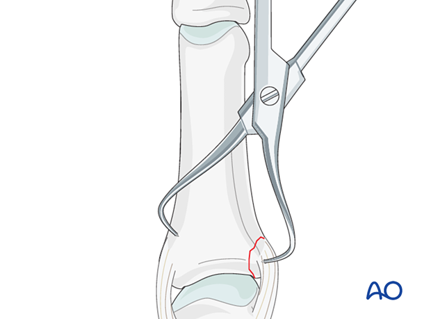 Reduction with small pointed reduction forceps of a proximal articular avulsion fracture of the proximal phalanx – hand.