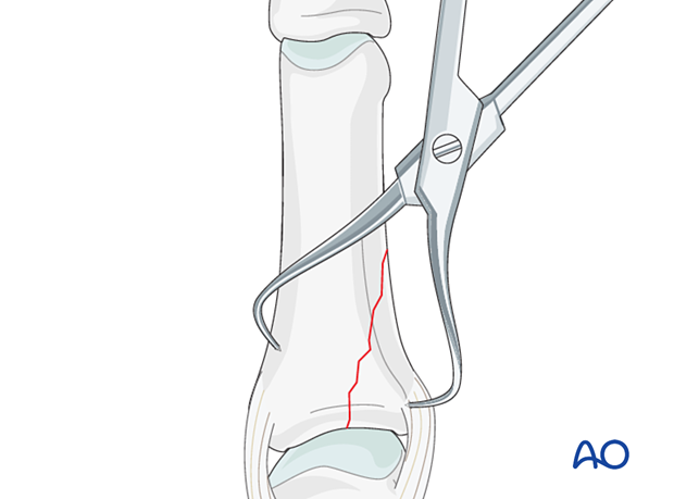 Reduction with small pointed reduction forceps of a proximal partial articular fracture of the proximal phalanx - hand