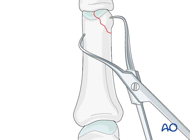 Reduction with small pointed reduction forceps of a proximal articular avulsion fracture of the distal phalanx - hand