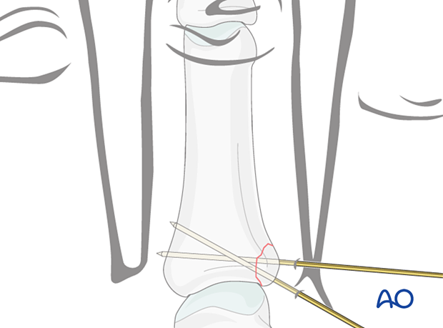 73 P420 K wire fixation