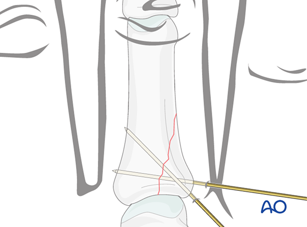 K-wire fixation of a proximal partial articular fracture of the proximal phalanx – hand.