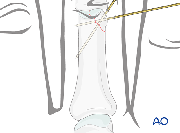 K-wire fixation of a proximal articular avulsion fracture of the distal phalanx - hand