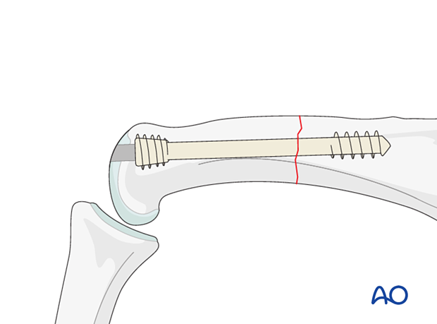 Intramedullary screw fixation of a transverse fracture of the proximal phalangeal shaft