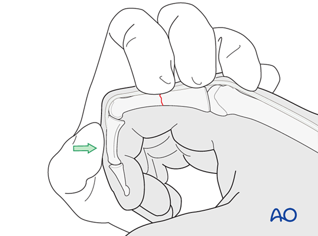 Reduction of a transverse fracture of the proximal phalangeal shaft