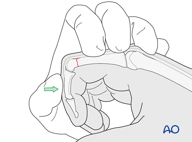 Reduction of a transverse fracture of the proximal phalangeal distal end segment