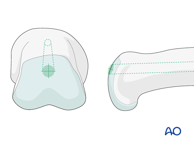 Insertion point for retrograde intramedullary screw fixation of proximal phalangeal fractures